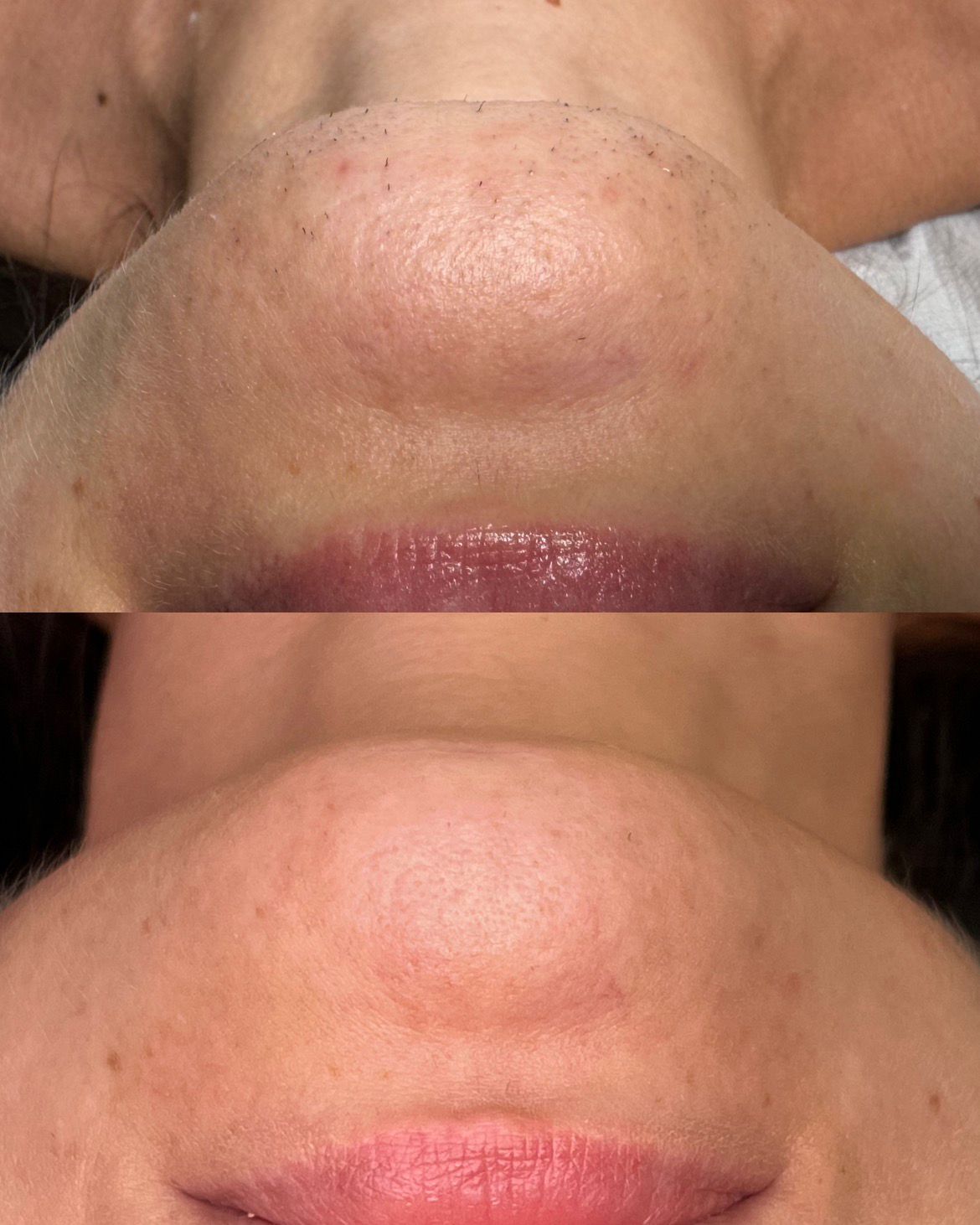 Efekt zabiegów epilacji laserowej