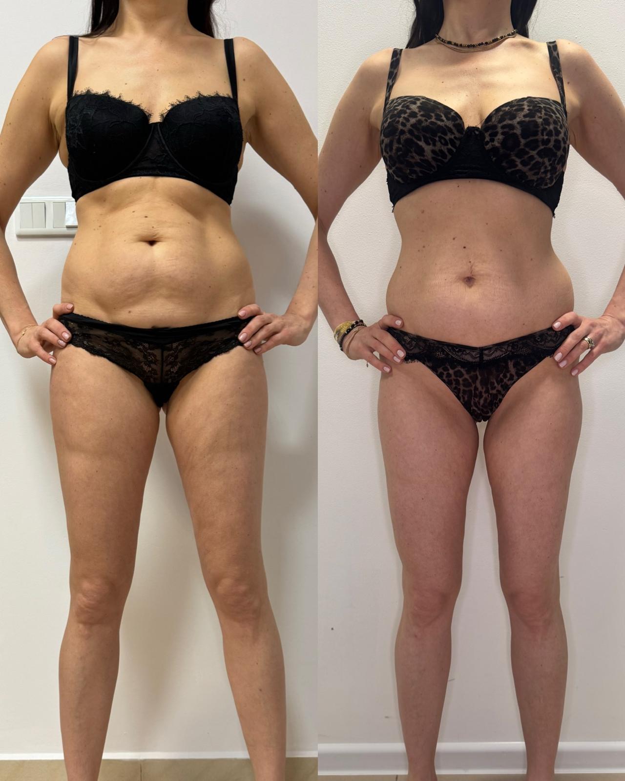 Indywidualnie dobrana terapia modelowania sylwetki w połączeniu ze zmianą nawyków żywieniowych