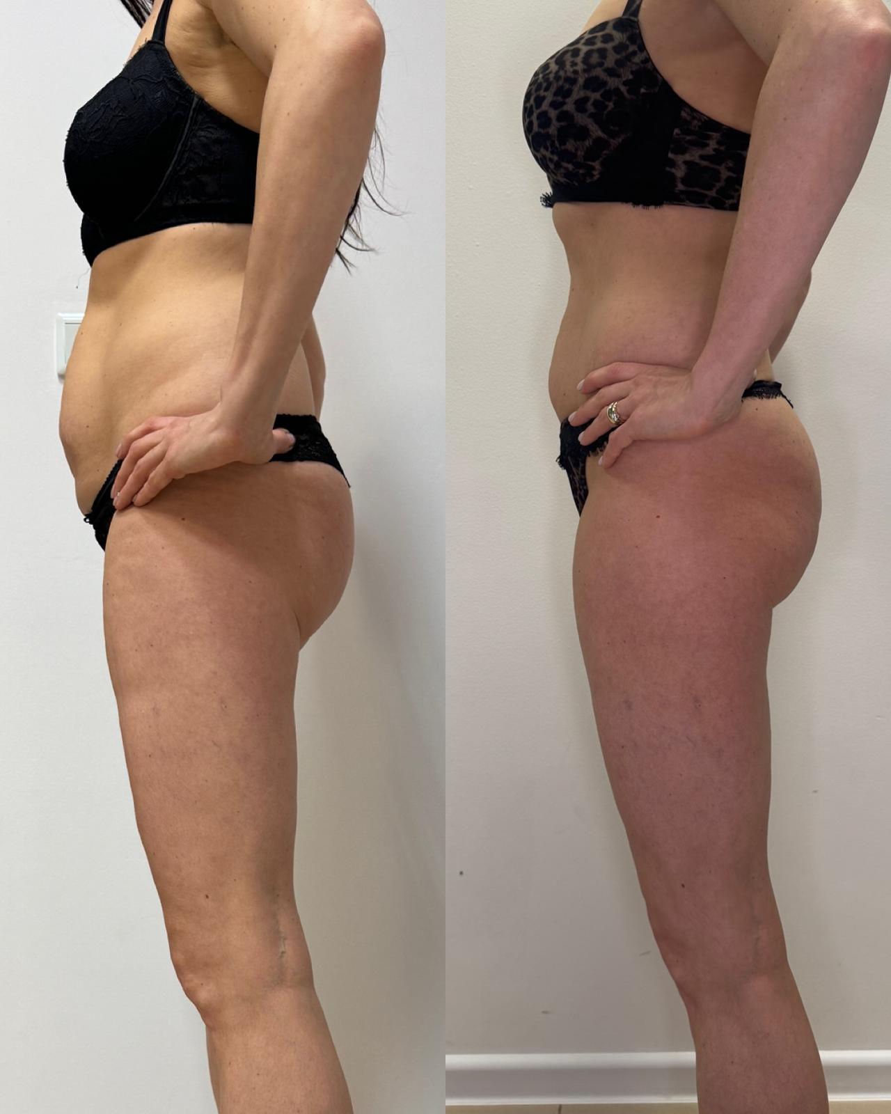 Indywidualnie dobrana terapia modelowania sylwetki w połączeniu ze zmianą nawyków żywieniowych