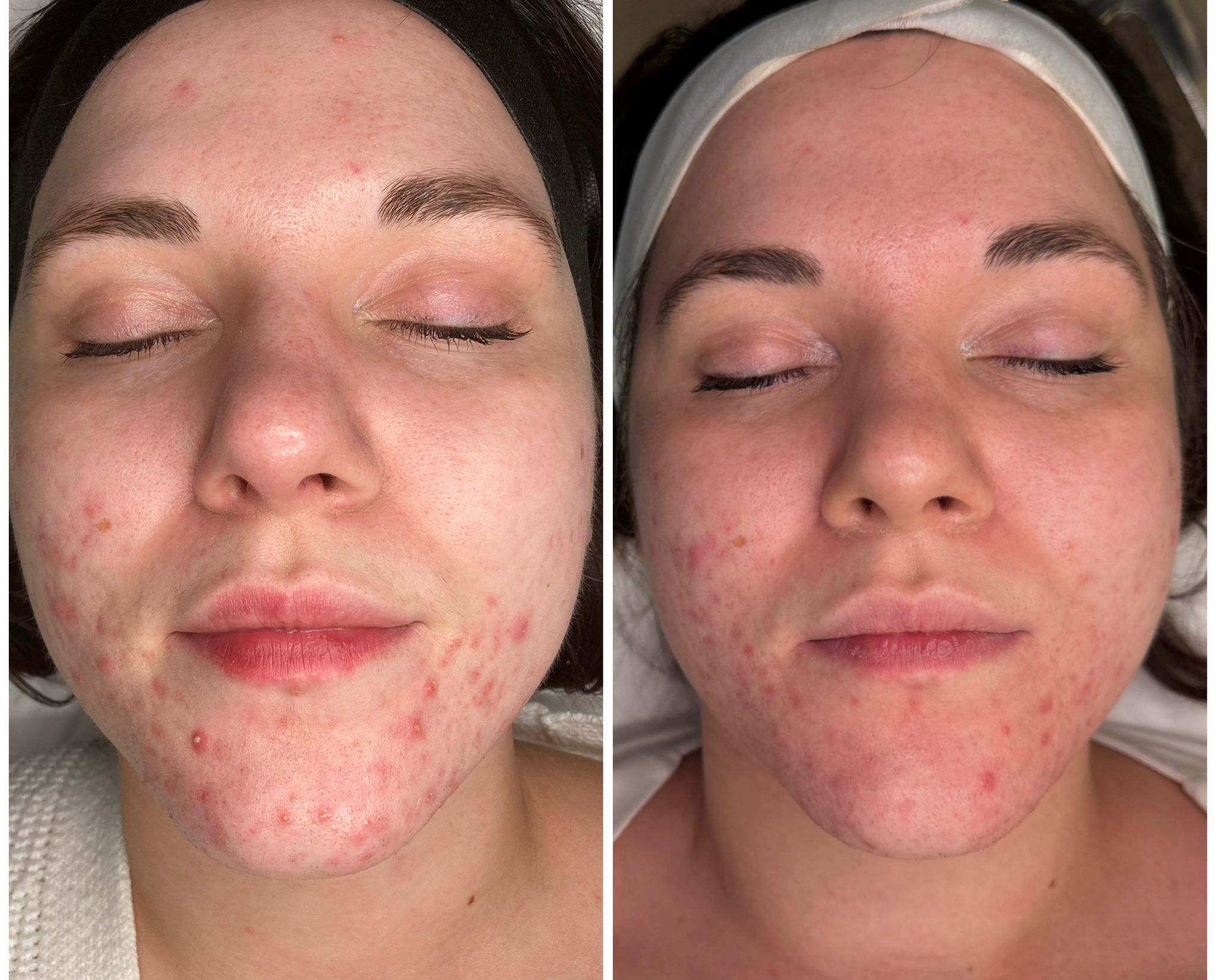 Leczenie trądziku światłem szerokopasmowym - efekt po 2 zabiegach, w trakcie leczenia
