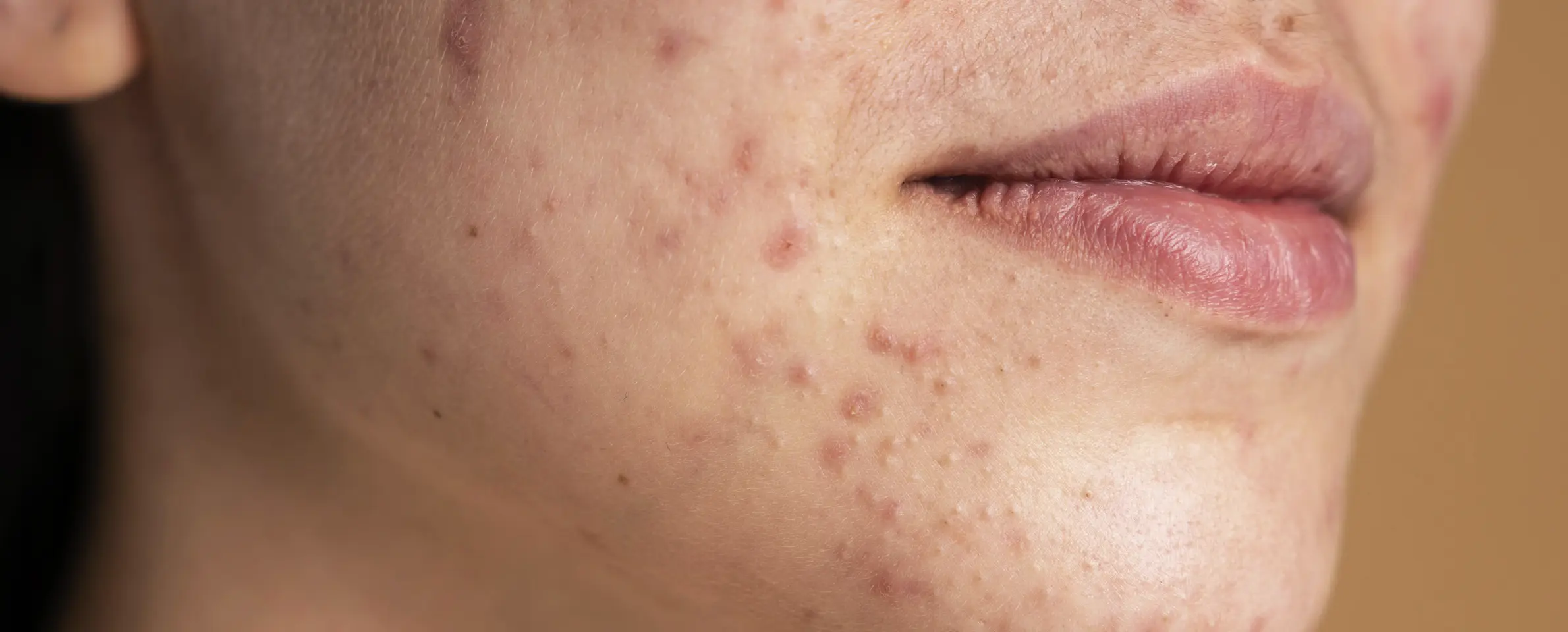 Trądzik u&nbsp;dorosłych – przyczyny i&nbsp;naturalne metody wsparcia