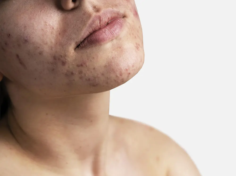 Trądzik u dorosłych - przyczyny i naturalne metody wsparcia