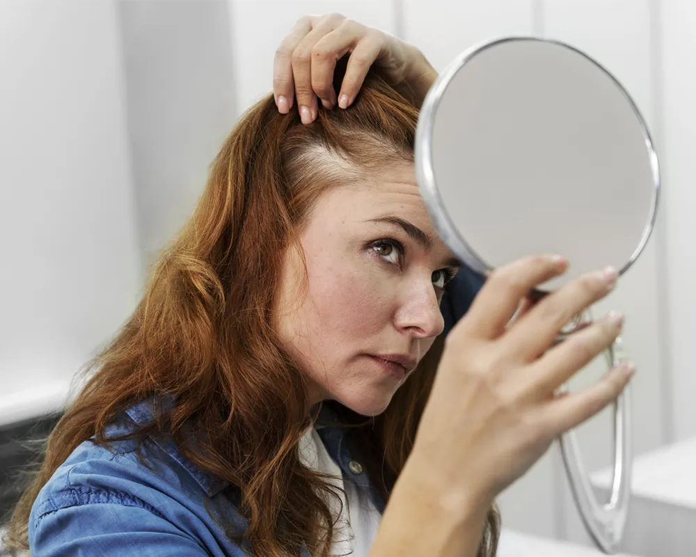 Łysienie androgenowe u kobiet