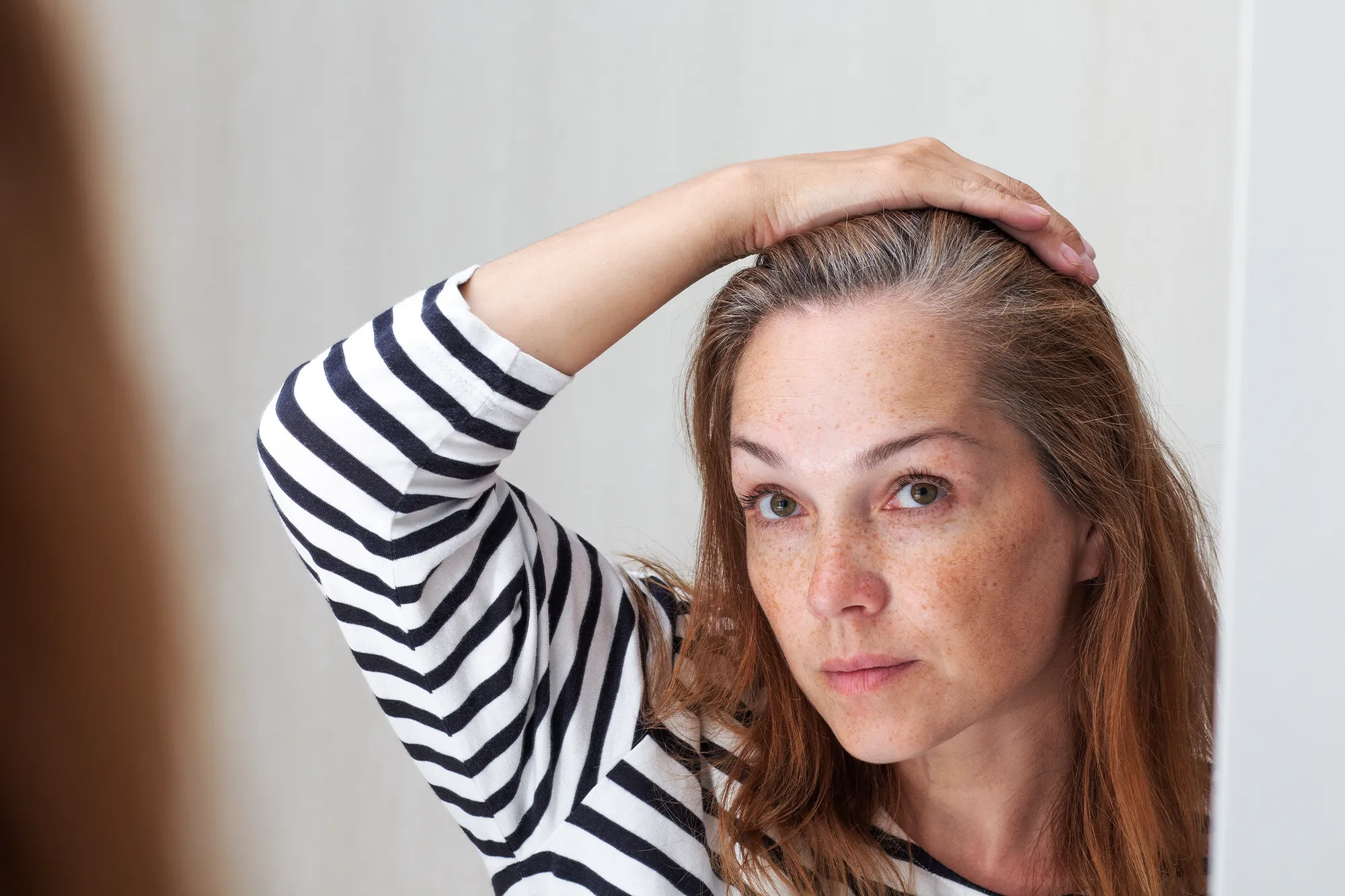 Łysienie androgenowe u kobiet przyczyny