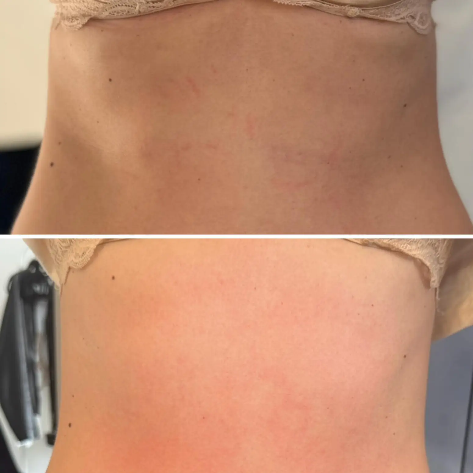 Wygładzenie struktury skóry w okolicy talii, - 3 cm po jednym zabiegu