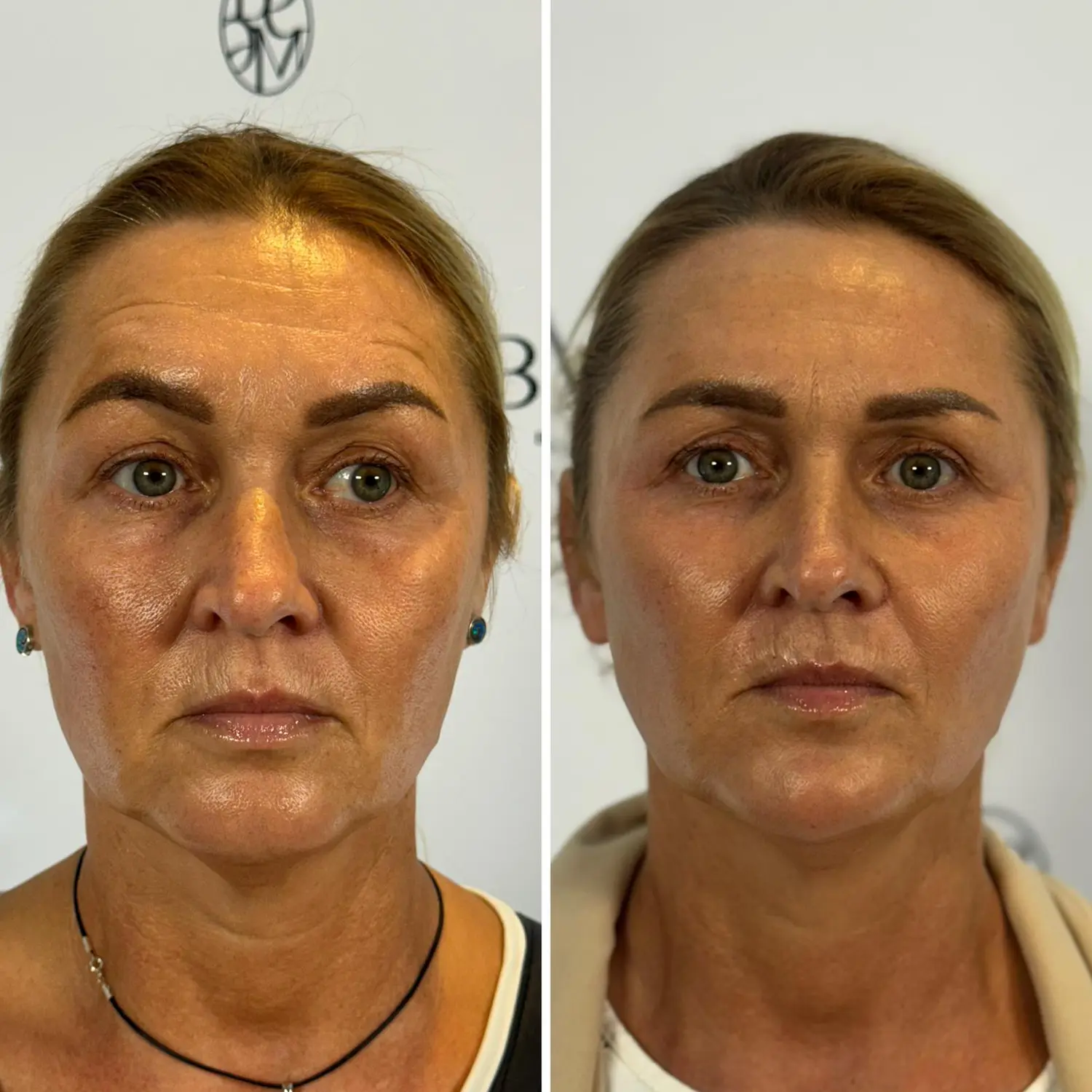 DIAMOND LIFT – Autorska procedura Dr Joanny