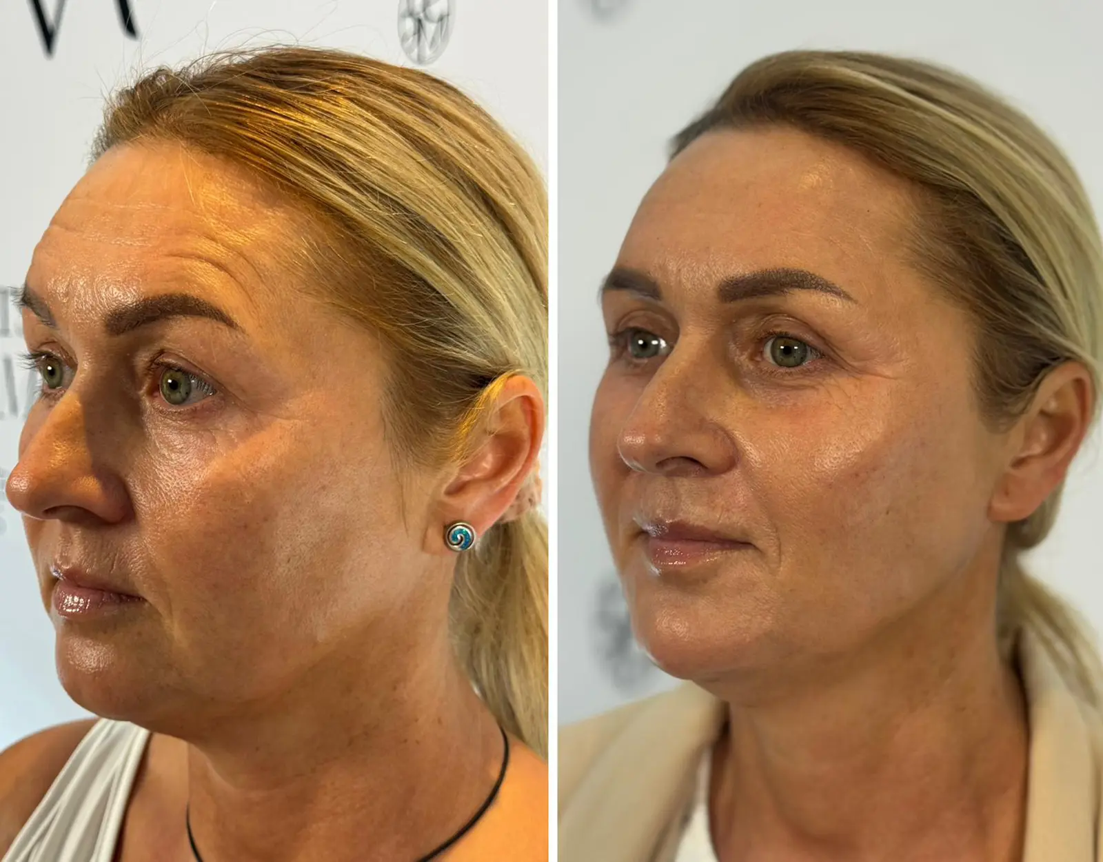 DIAMOND LIFT – Autorska procedura Dr Joanny