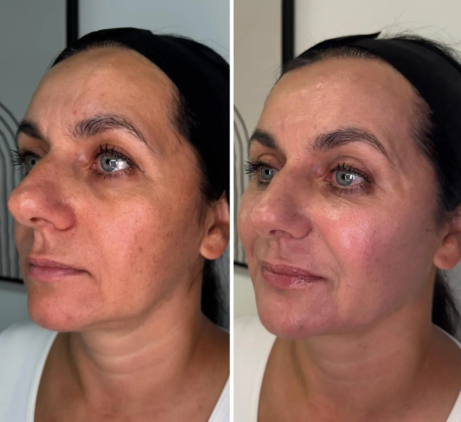 DIAMOND LIFT – Autorska procedura Dr Joanny