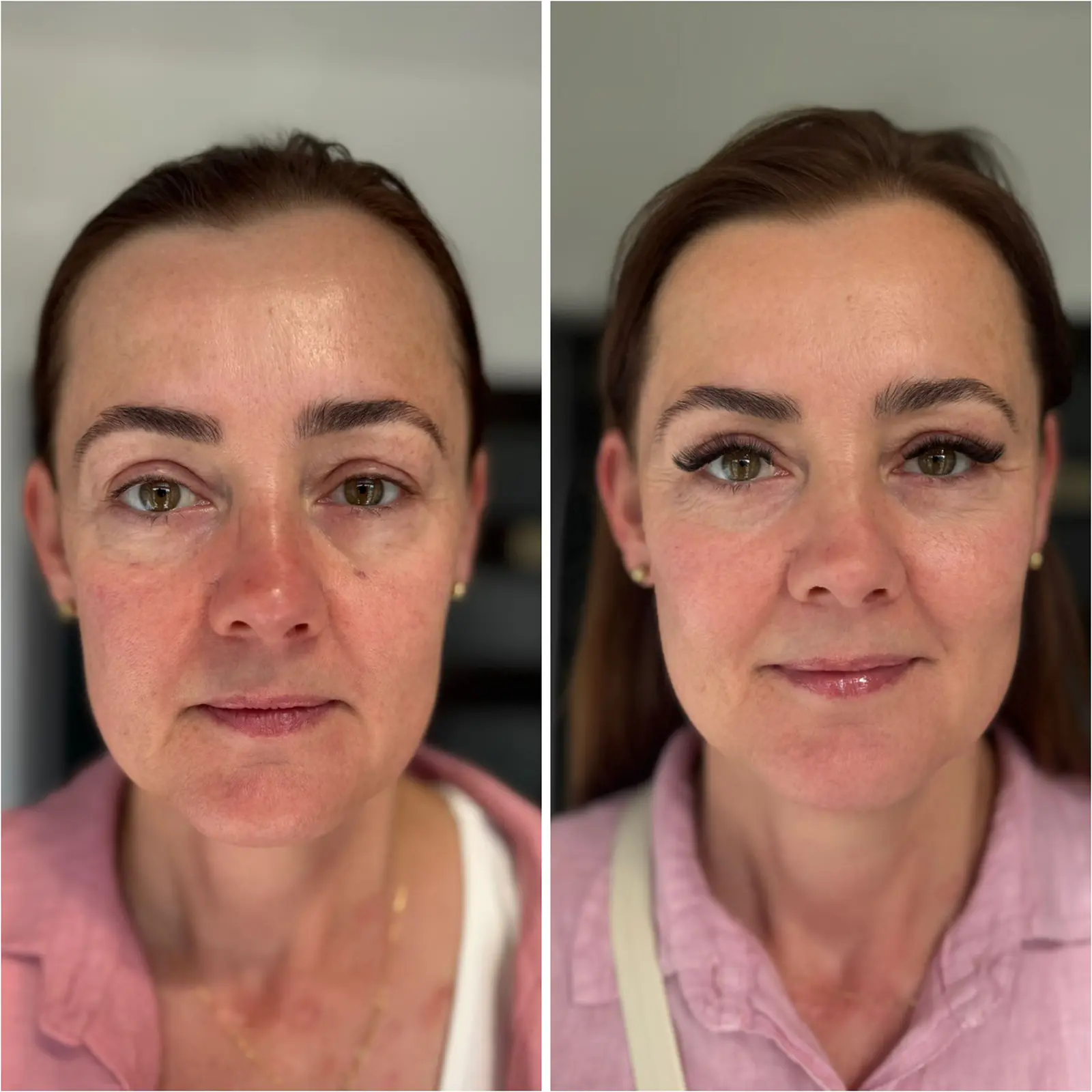 DIAMOND LIFT – Autorska procedura Dr Joanny