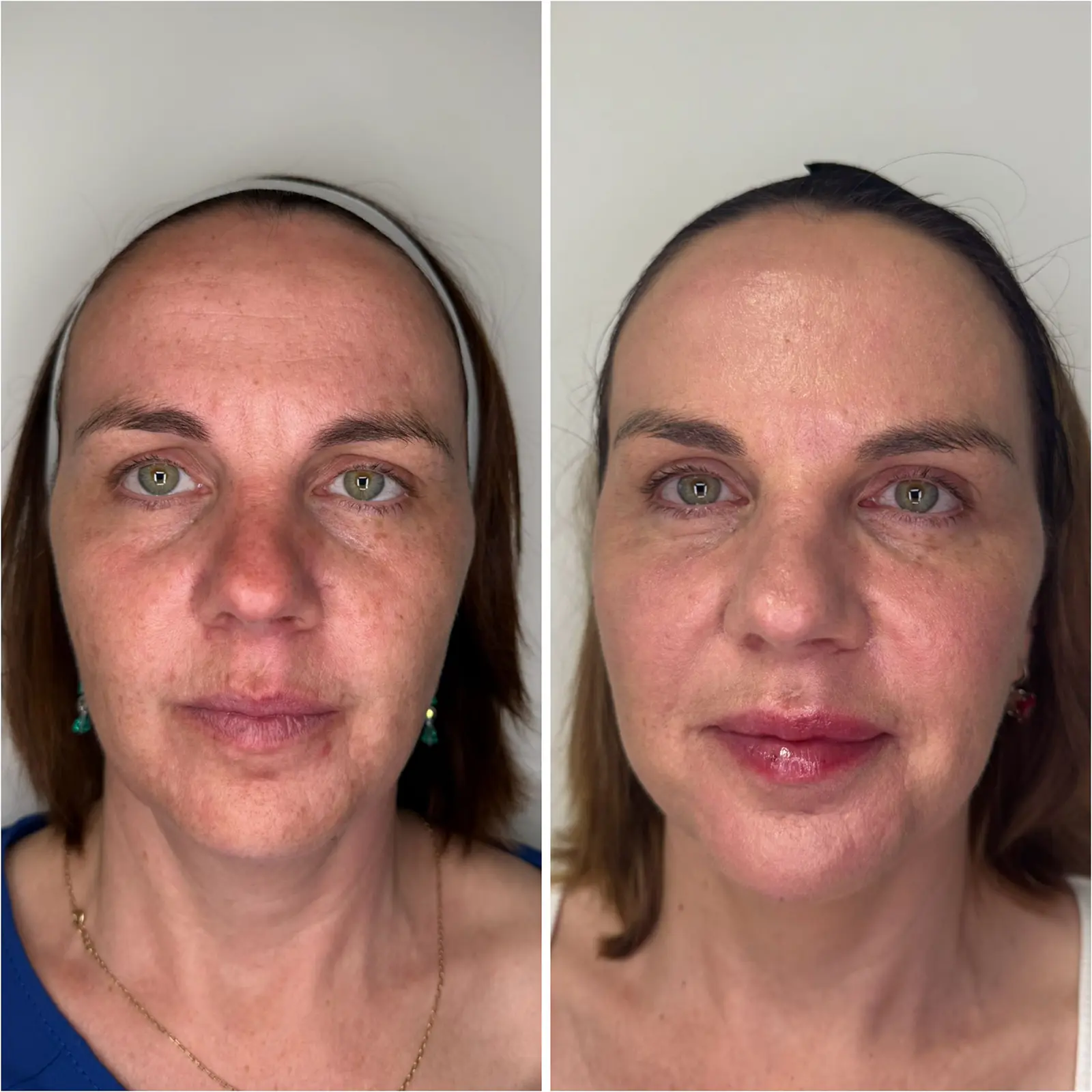 Kontynuacja terapii – u Pacjentki został wykonany Diamond Lift - Autorska procedura Dr Joanny