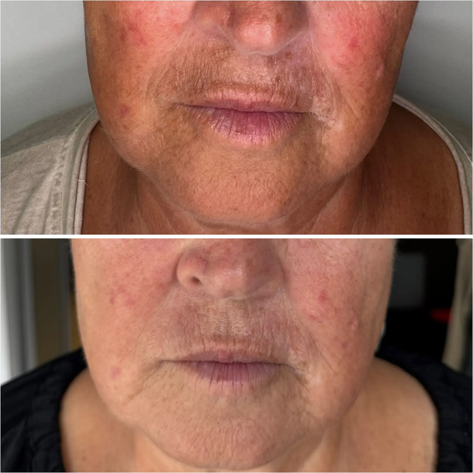 Efekt 1 zabiegu laserem tulowym Lavieen