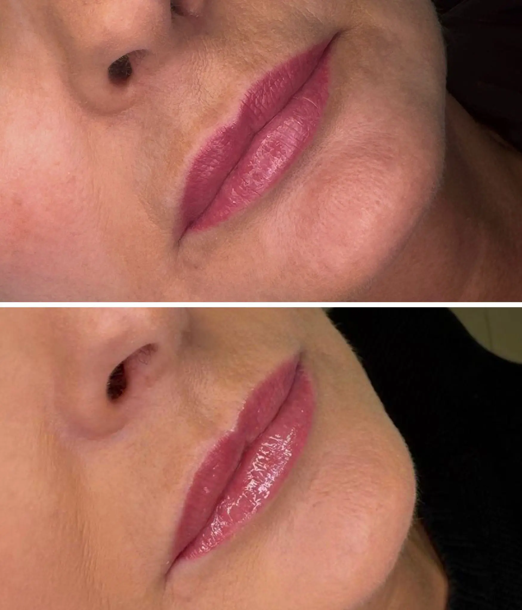 Regeneracja usta laserem tulowym w połączeniu z mezoterapią