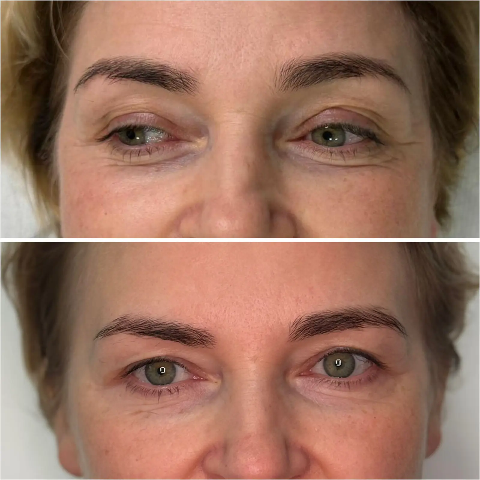 Stymulator tkankowy połączaony z laserem tulowym