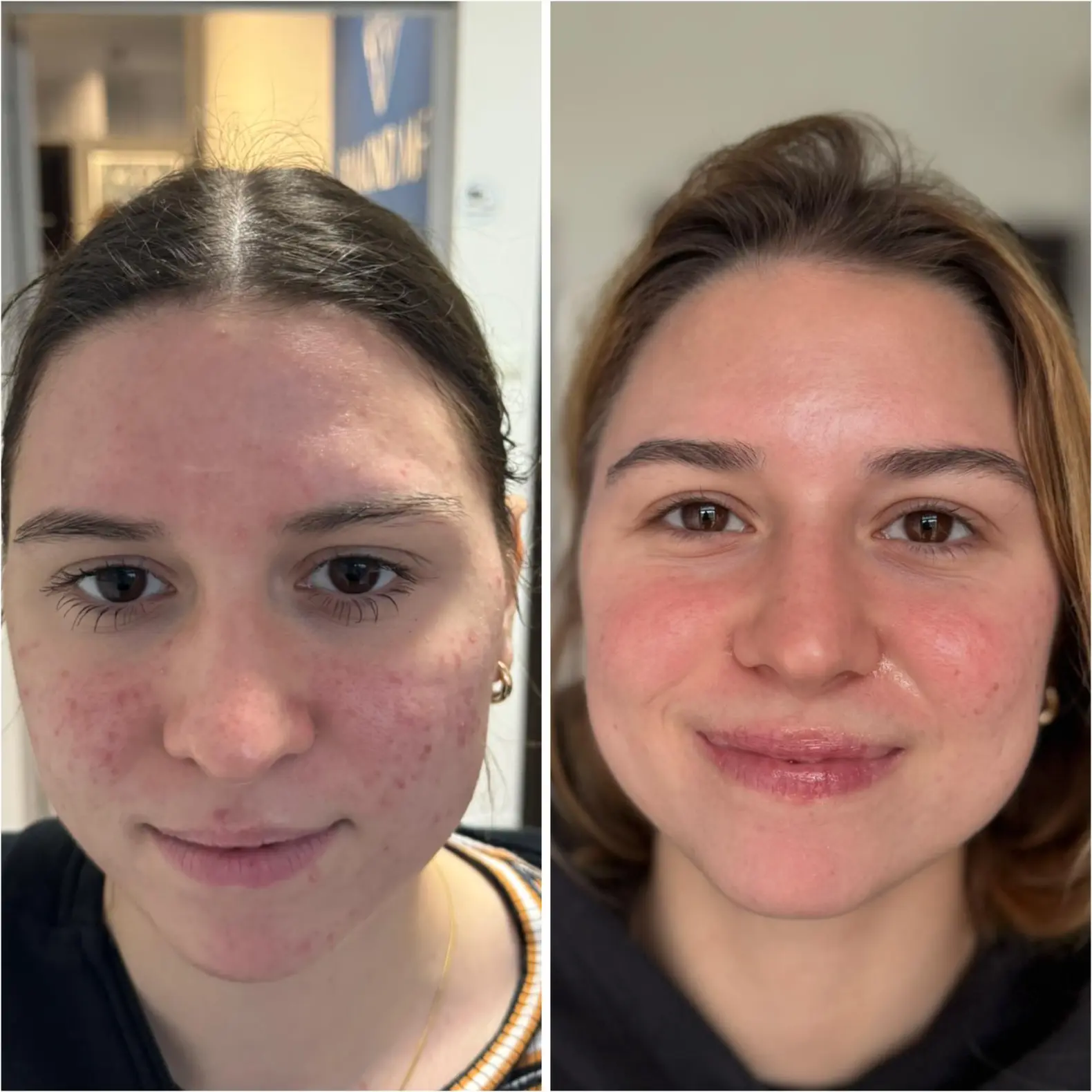 Indywidualnie dobrana terapia leczenia trądziku + zabieg z użyciem światła szerokopasmowego BB