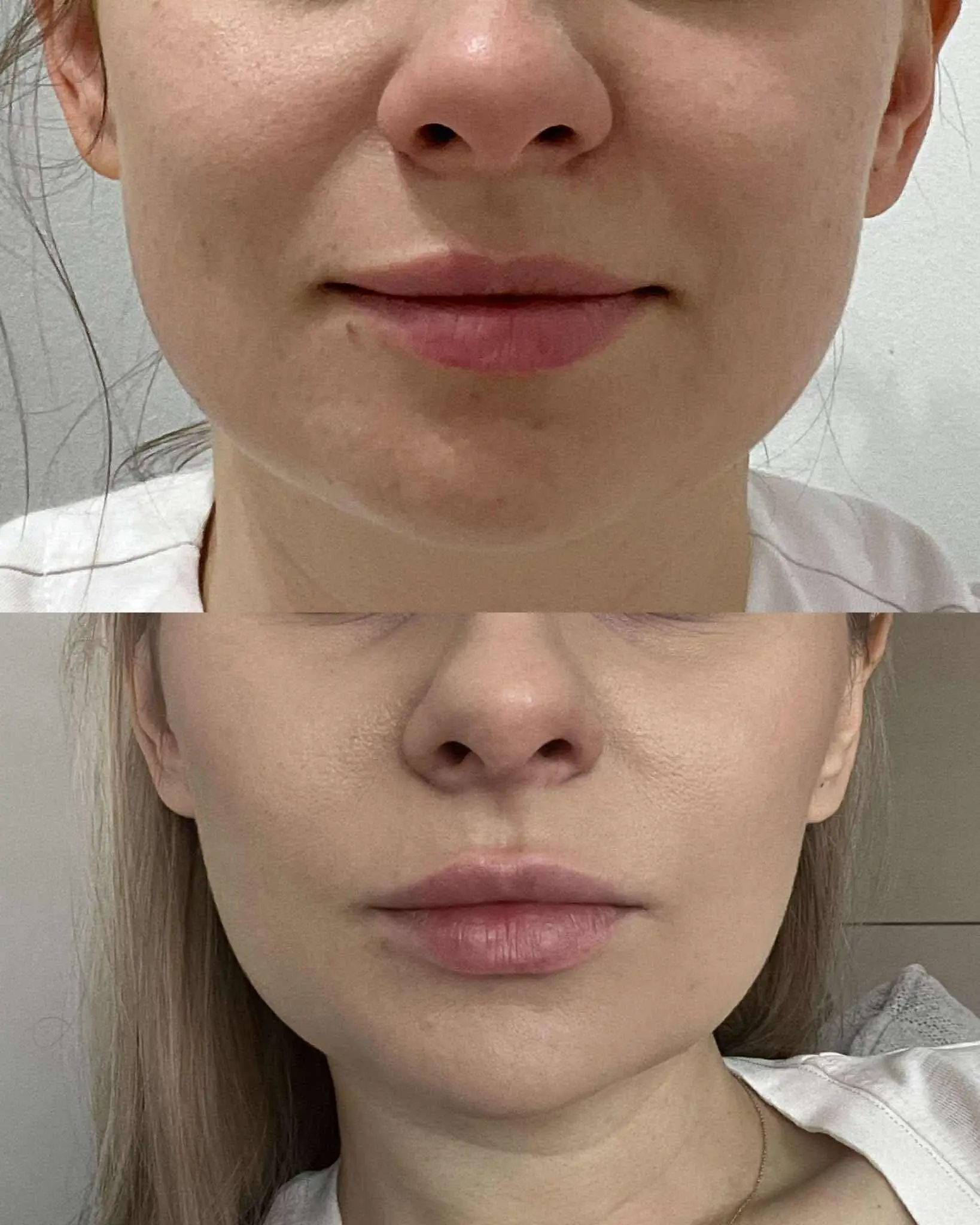 Leczenie bruksizmu toksyną botulinową, uzyskany efekt estetyczny wyszczuplenia dolnej części twarzy