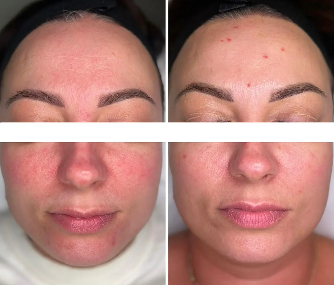 Leczenie trądziku różowatego światłem szerokopasmowym BB