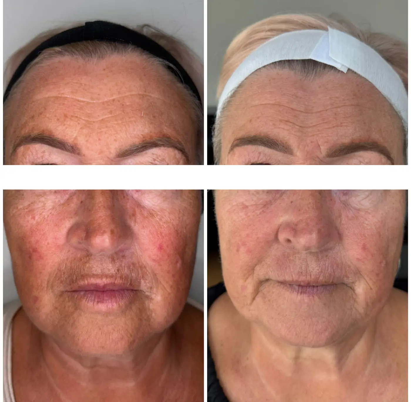 Efekt 1 zabiegu laserem tulowym Lavieen