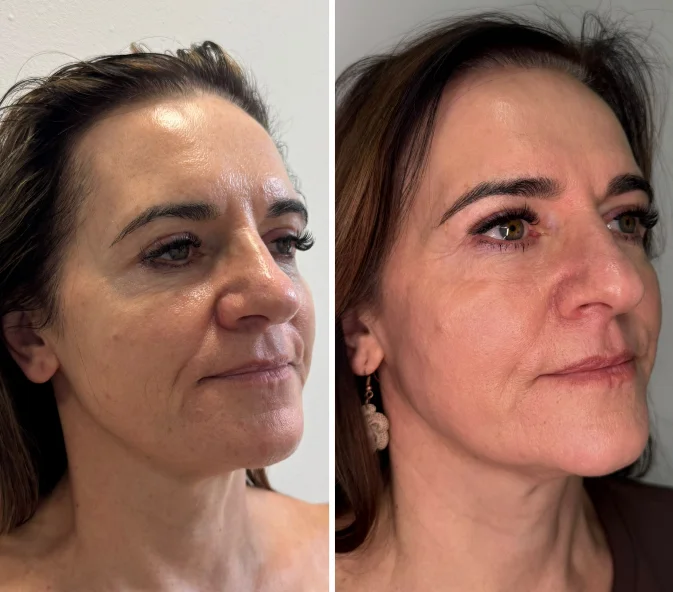 Poprawa jakości skóry przetłuszczającej się laserem tułowym