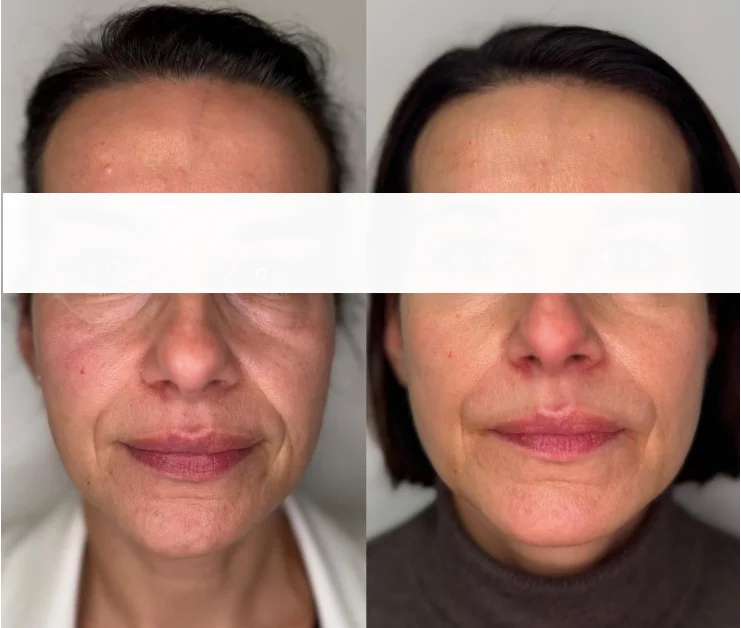 Indywidualnie dobrane zabiegi z zakresu medycyny estetycznej