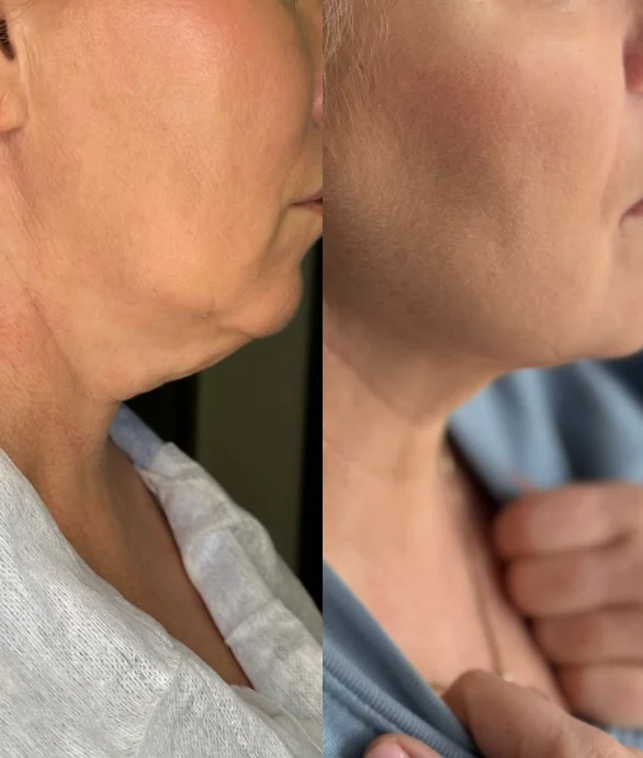 Indywidualnie dobrany plan terapii redukującej podwójny podbródek