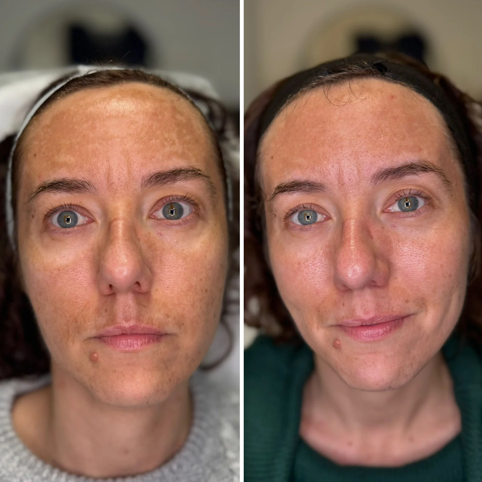 Leczenie przebarwień laserem tułowym