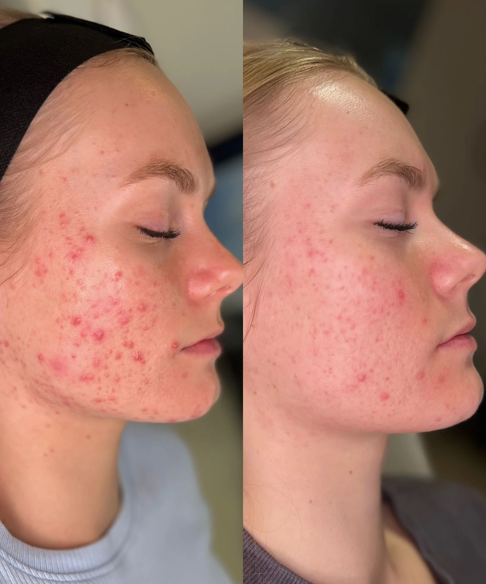 Leczenie trądziku światłem szerokopasmowym i indywidualnie dobraną terapią