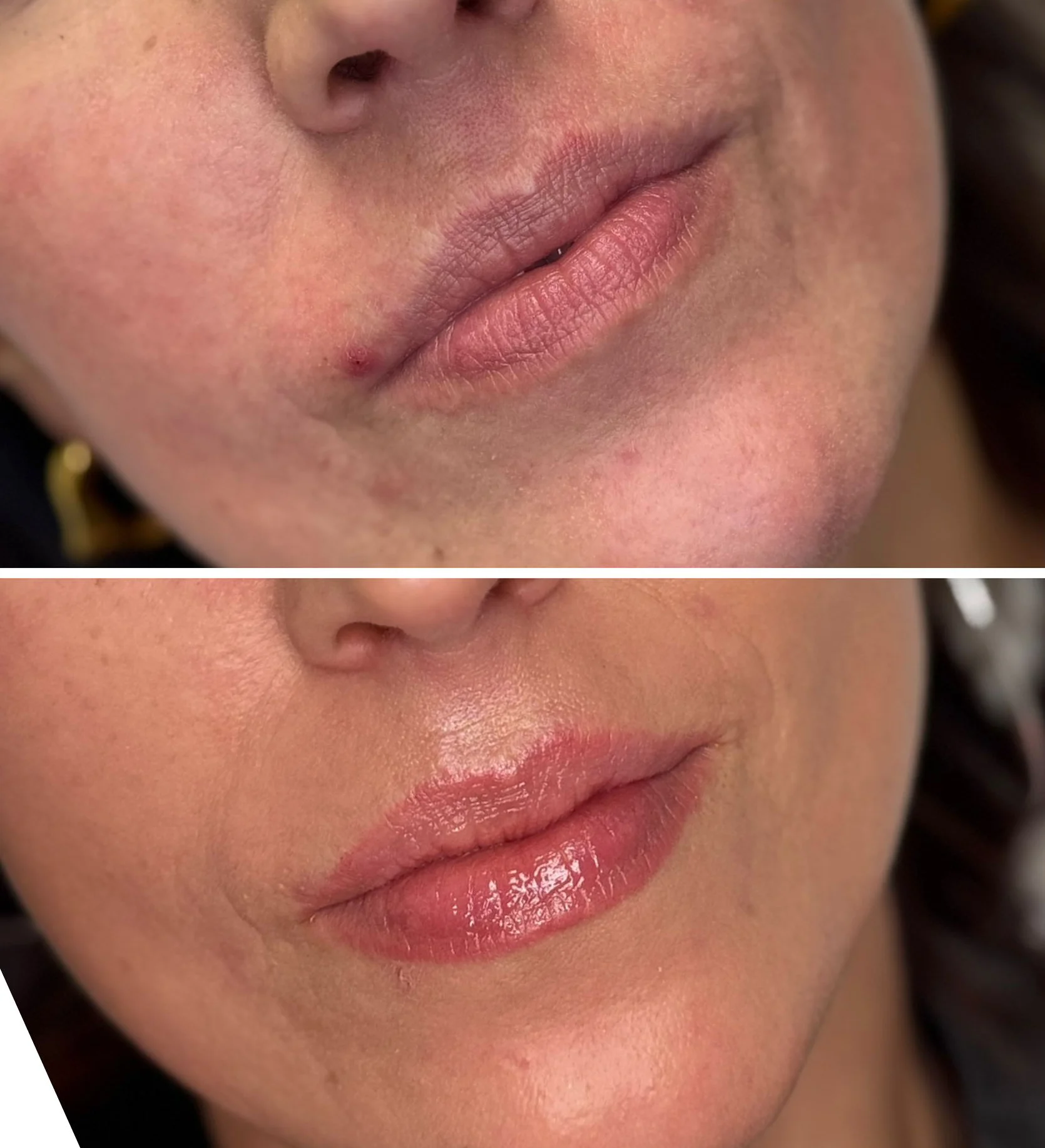 Nawilżanie oraz regeneracja ust i okolicy ust laserem tułowym