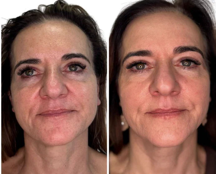 Poprawa jakości skóry przetłuszczającej się laserem tułowym