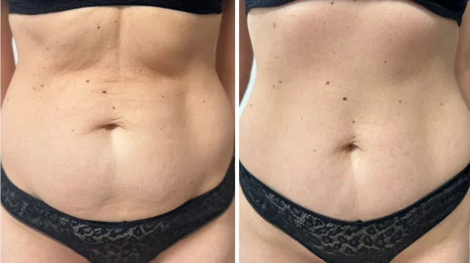 Poprawa wiotkości skóry dzięki laserowi tułowemu