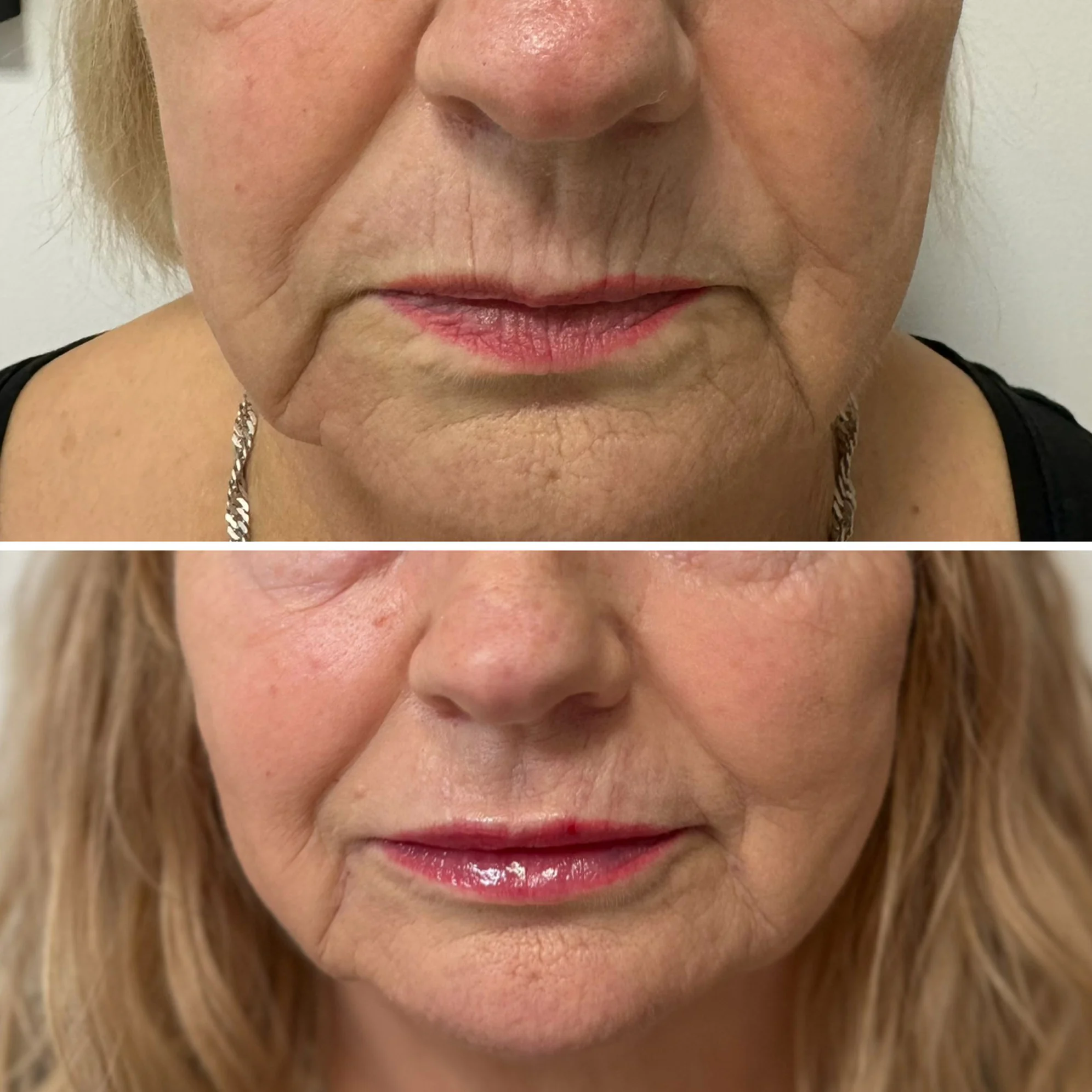 Efekt powiększania ust i redukcji zmarszczek okolicy ust kwasem hialuronowym – Diamond Med Sieradz