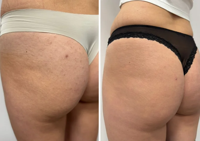 Redukcja przebarwień i rozstępów laserem tułowym