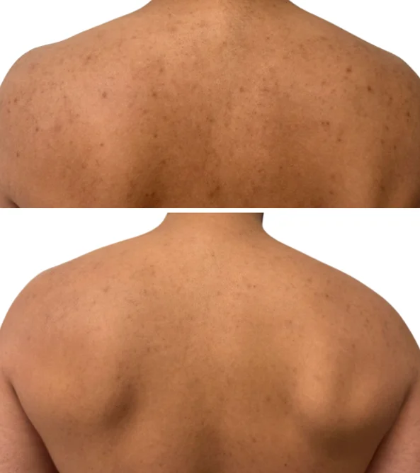 Redukcja przebarwień pozapalnych laserem tułowym