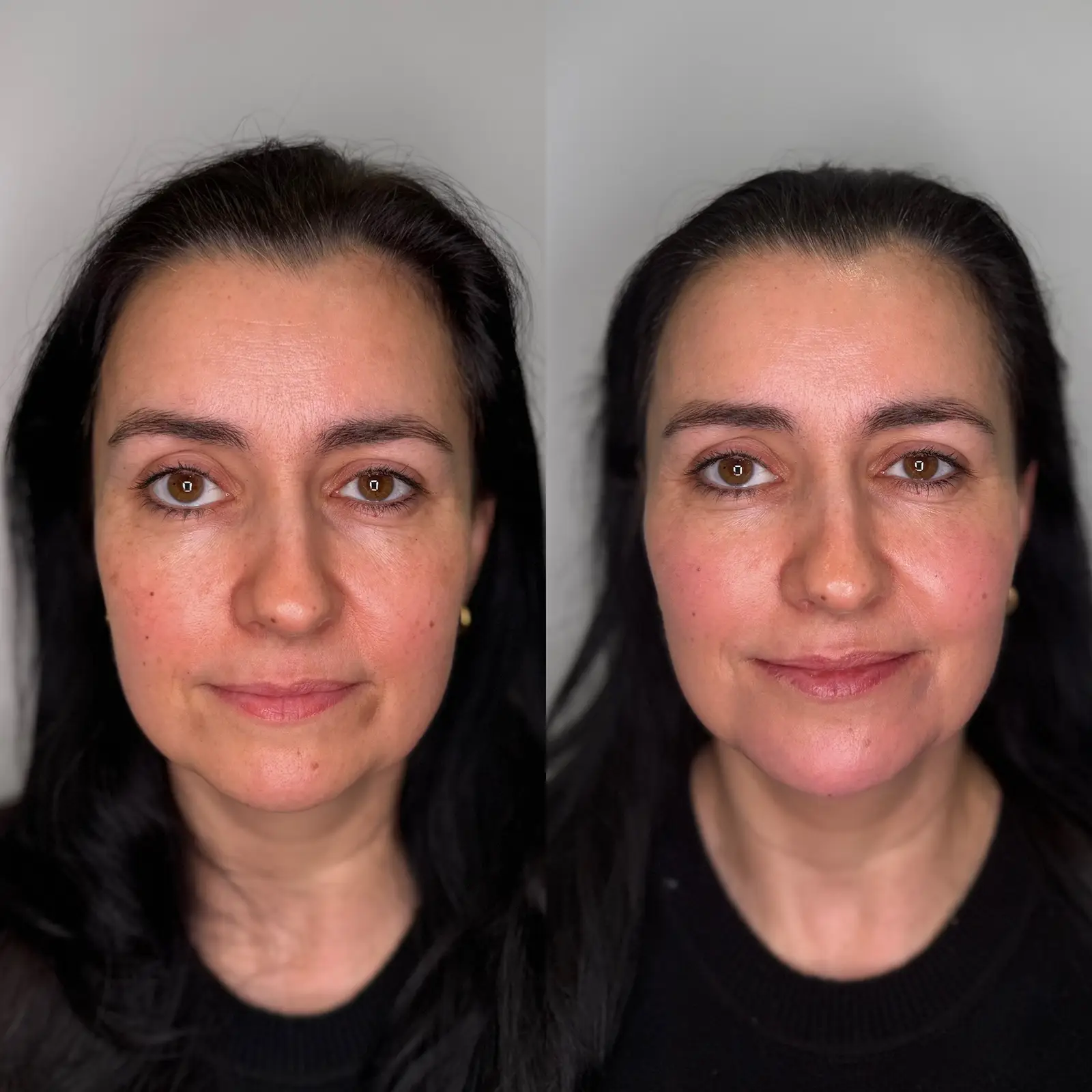 Diamond Boost - autorski zabieg Dr Joanny Gralińskiej-Wyrębskiej